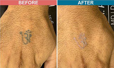 Laser-Tattoo-Removal-Skinaa-Clinic-Before-After-5