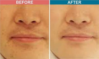 Laser-Toning-Treatment-For-Pigmentation-Before-After-Skinaa-Clinic-2