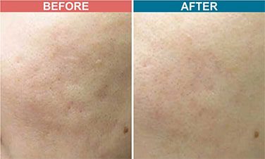 Laser-Toning-Treatment-For-Pigmentation-Before-After-Skinaa-Clinic-3