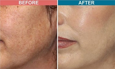 Laser-Toning-Treatment-For-Pigmentation-Before-After-Skinaa-Clinic-4