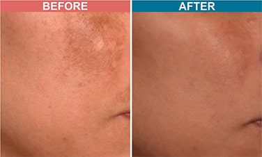 Laser-Toning-Treatment-For-Pigmentation-Before-After-Skinaa-Clinic-5