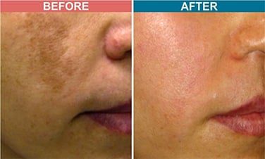 Laser-Toning-Treatment-For-Pigmentation-Before-After-Skinaa-Clinic-6