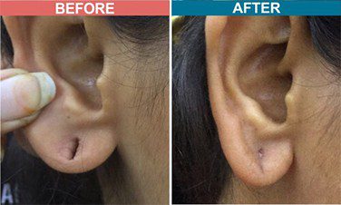 Laser-Treatment-For-Ear-Lob-Repair-skinaa-clinic-Befor-After-1
