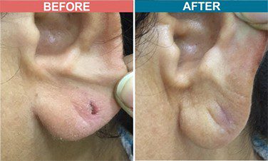 Laser-Treatment-For-Ear-Lob-Repair-skinaa-clinic-Befor-After-2