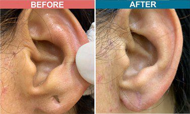 Laser-Treatment-For-Ear-Lob-Repair-skinaa-clinic-Befor-After-3