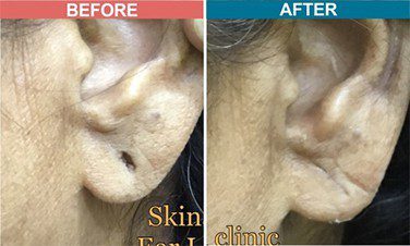 Laser-Treatment-For-Ear-Lob-Repair-skinaa-clinic-Befor-After-4