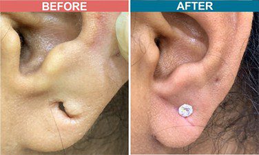 Laser-Treatment-For-Ear-Lob-Repair-skinaa-clinic-Befor-After-5