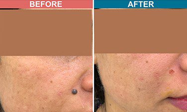 Laser-Treatment-For-Mole-Wart-Removal-Before-After-Skinaa-Clinic-1