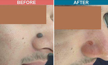 Laser-Treatment-For-Mole-Wart-Removal-Before-After-Skinaa-Clinic-2