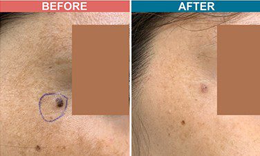 Laser-Treatment-For-Mole-Wart-Removal-Before-After-Skinaa-Clinic-3