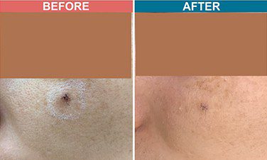 Laser-Treatment-For-Mole-Wart-Removal-Before-After-Skinaa-Clinic-4