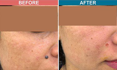 Laser-Treatment-For-Mole-Wart-Removal-Before-After-Skinaa-Clinic-5
