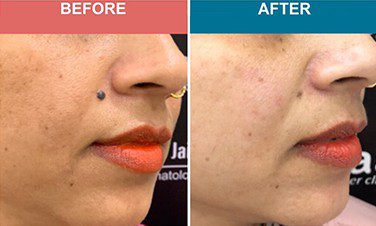 Laser-Treatment-For-Mole-Wart-Removal-Before-After-Skinaa-Clinic-6