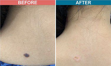 Laser-Treatment-For-Mole-Wart-Removal-Before-After-Skinaa-Clinic-7
