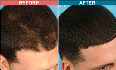 Low-Light-Laser-Therapy-For-Hair-Fall-Before-After-1