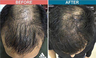 Low Light Laser Treatment for Hair Fall | Men & Women Hair Loss
