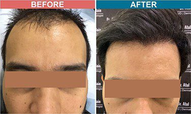 Low-Light-Laser-Therapy-For-Hair-Fall-Before-After-3