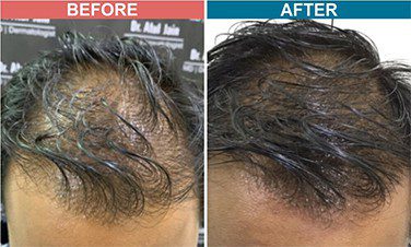Low Light Laser Treatment for Hair Fall | Men & Women Hair Loss