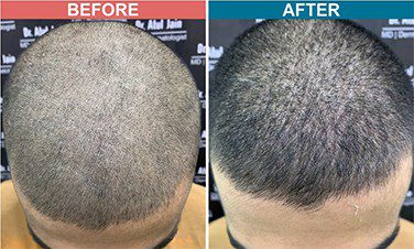 Low-Light-Laser-Therapy-For-Hair-Fall-Before-After-5