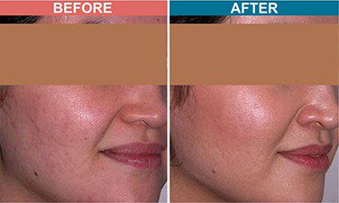 MESOTHERAPY-Treatment-For-Pigmentation-Skinaa-Clinic-2