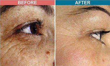 MESOTHERAPY-Treatment-For-Pigmentation-Skinaa-Clinic-4