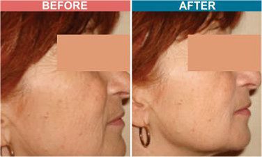 MESOTHERAPY-Treatment-For-Pigmentation-Skinaa-Clinic-5