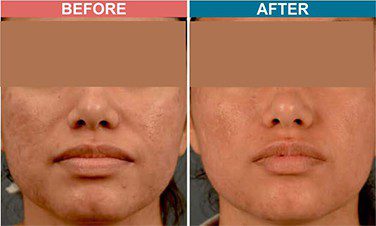 MICRODERMABRASION-Treatment-For-Pigmentation-before-after-Skinaa-Clinic-1