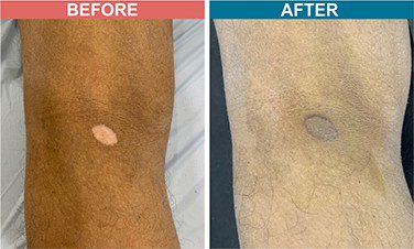 Micropigmentation-Treatment-For-Vitiligo-Before-After-Skinaa-Clinic-1