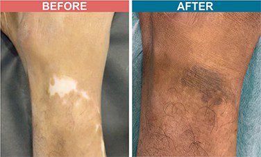 Micropigmentation-Treatment-For-Vitiligo-Before-After-Skinaa-Clinic-2