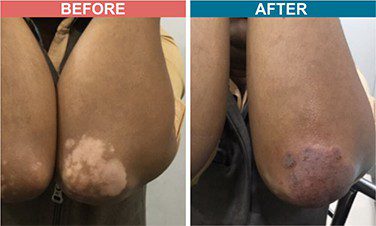 Micropigmentation-Treatment-For-Vitiligo-Before-After-Skinaa-Clinic-3