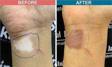 Micropigmentation-Treatment-For-Vitiligo-Before-After-Skinaa-Clinic-4