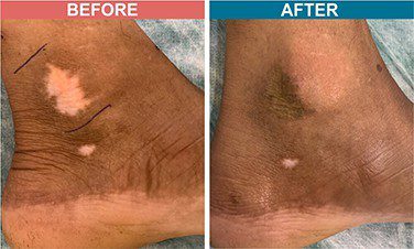 Micropigmentation-Treatment-For-Vitiligo-Before-After-Skinaa-Clinic-5