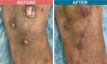 Micropigmentation-Treatment-For-Vitiligo-Before-After-Skinaa-Clinic-6