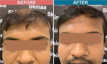 PRP-with-Derma-roller-treatment-skinaa-clinic-before-after-5
