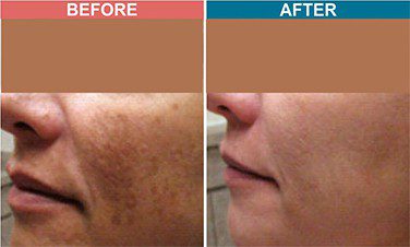 Peel-Treatment-For-Skin-Lightenign_Whitening-Before-After-Skinaa-Clinic-3