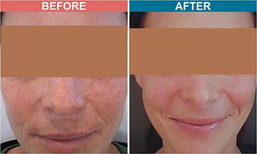Peel-Treatment-For-Skin-Lightenign_Whitening-Before-After-Skinaa-Clinic-4