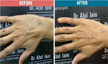 Wart-Removal-Treatment-Skinaa-Clinic-Before-After-1