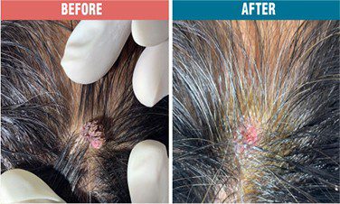 Wart-Removal-Treatment-Skinaa-Clinic-Before-After-2
