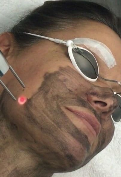 Co2 Laser Facial Treatment in Udaipur Carbon Laser for Pigmentation