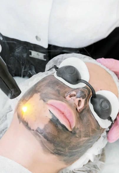 Co2 Laser Facial Treatment in Ajmer | Carbon Laser for Pigmentation