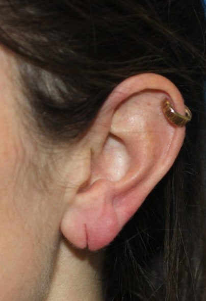 Earlobe Repair in Jaipur  Suture Free Earlobe Repair Treatment in Jaipur