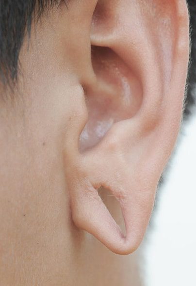 Suture-Free Ear Lobe Repair at Skinaa Clinic