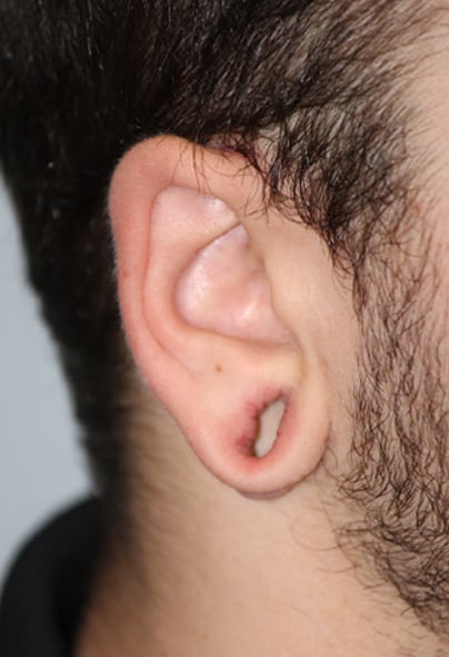 Earlobe Repair in Jodhpur  Suture Free Earlobe Repair Treatment in Jodhpur