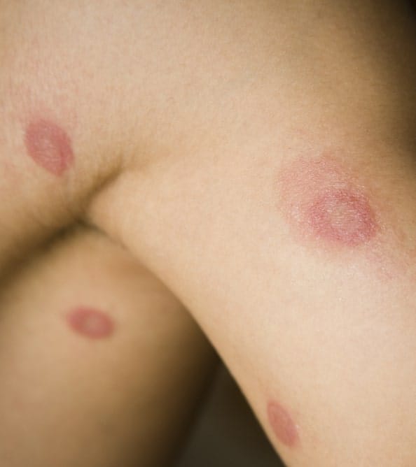 7 Signs a Skin Rash Could Indicate Something Serious