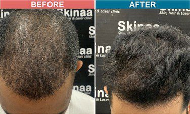 hair-transplant-treatment-at-skinaa-clinic-case-11