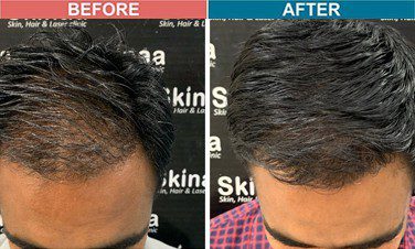 hair-transplant-treatment-at-skinaa-clinic-case-13