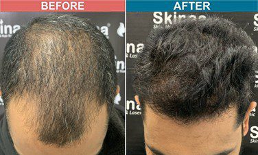hair-transplant-treatment-at-skinaa-clinic-case-2