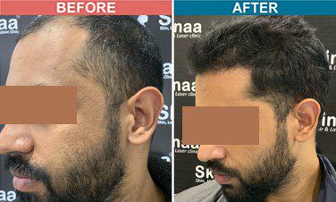 Hair Transplant Clinic in Guwahati Assam  Affordable Hair Treatment  NHT