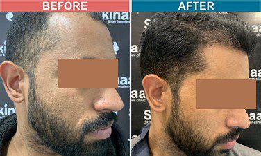 hair-transplant-treatment-at-skinaa-clinic-case-4