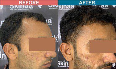 hair-transplant-treatment-at-skinaa-clinic-case-5